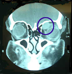 CAT scan showing tumor